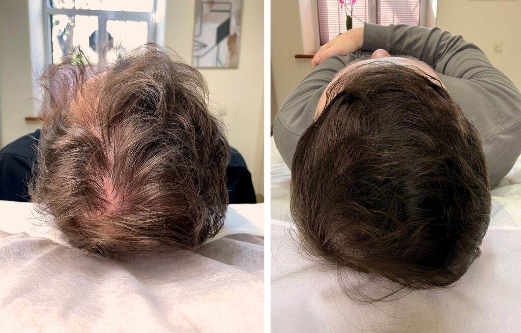 RedTouch PRO Kollagenlaser 4 227e8f7f aafa 49e6 9c8e f6bc324c3105