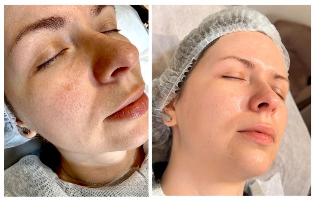 RedTouch PRO Kollagenlaser 2 IMG 1168