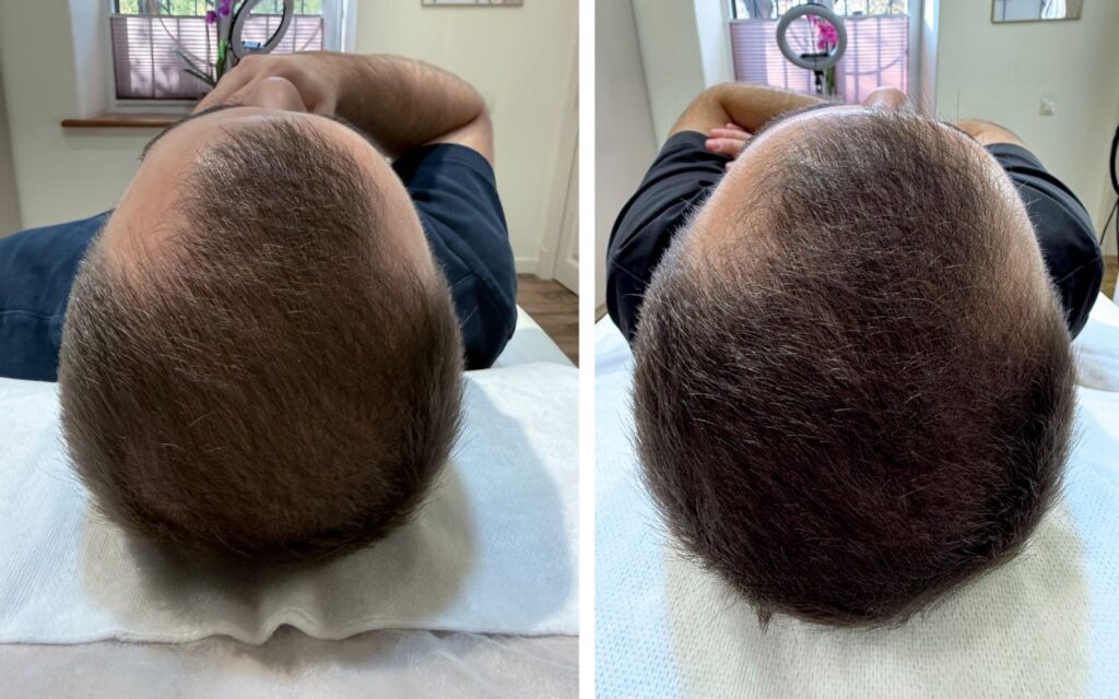 RedTouch PRO Kollagenlaser 3 b7d2c4ee 1225 4066 95c8 664722edbe63